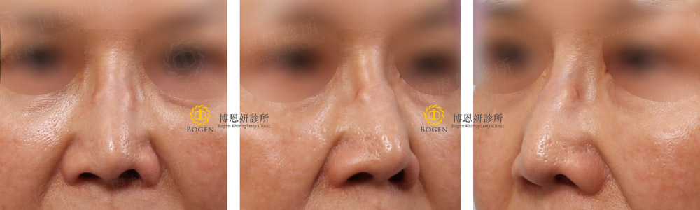 矽膠隆鼻重修案例,矽膠隆鼻,博恩妍